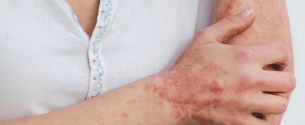 عکس روز جهانی پسوزیاریس