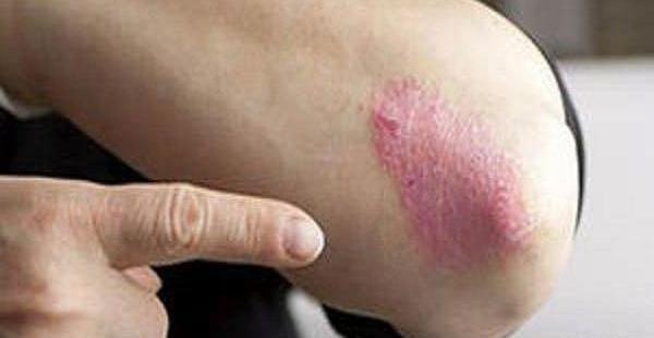 عکس روز جهانی پسوزیاریس