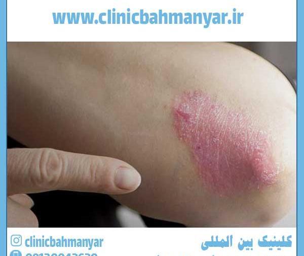 عکس روز جهانی پسوزیاریس