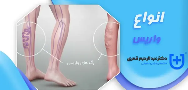عکس واریس خفیف پا