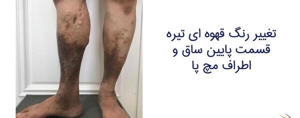 عکس واریس خفیف پا