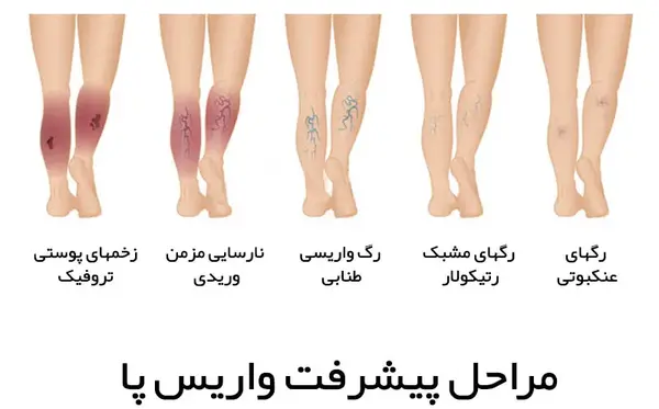 عکس واریس خفیف پا