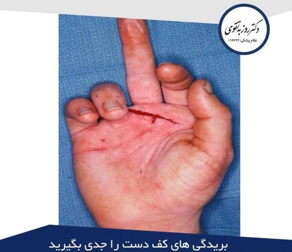 عکس ضرب دیدگی انگشت دست