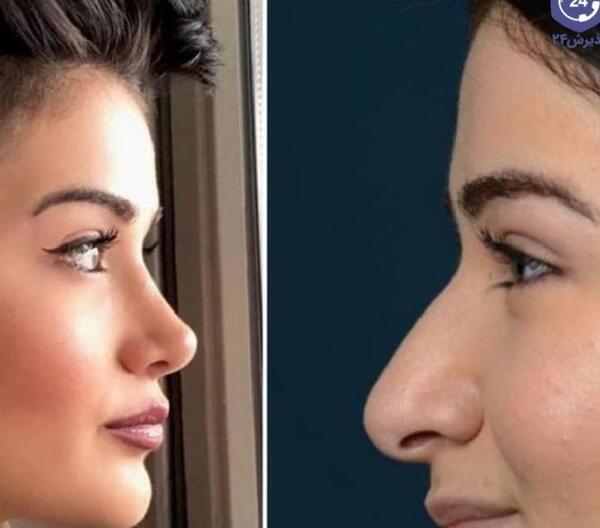 عکس فیک دختر دماغ عملی