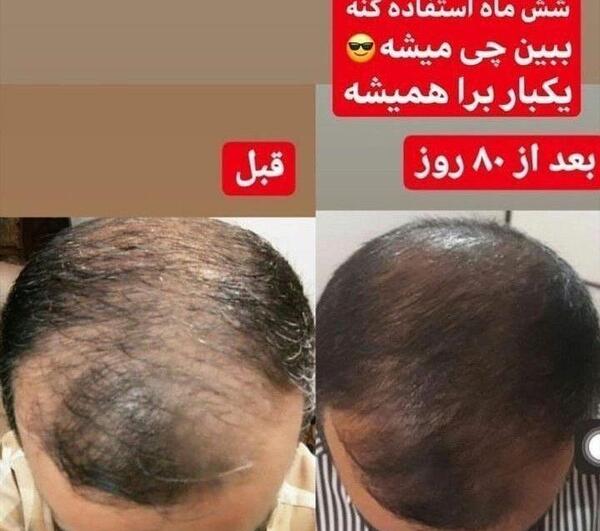 عکس تونیک ضد ریزش مو لدورا
