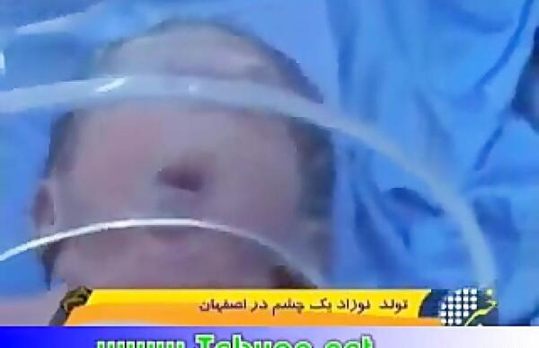 عکس دختر یک چشم