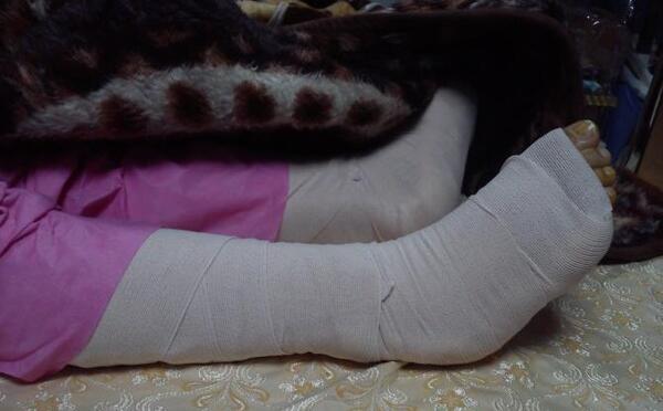 عکس فیک دست شکسته پسر