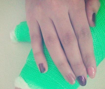 عکس فیک دست شکسته پسر