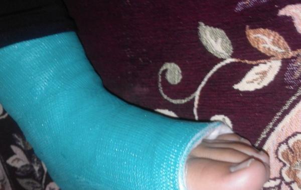 عکس فیک دست شکسته پسر