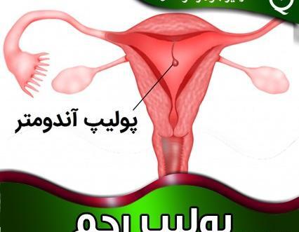 عکس پولیپ رحم