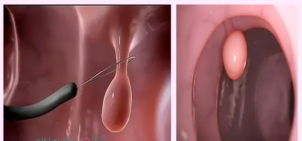 عکس پولیپ رحم