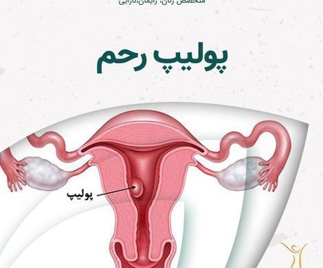 عکس پولیپ رحم