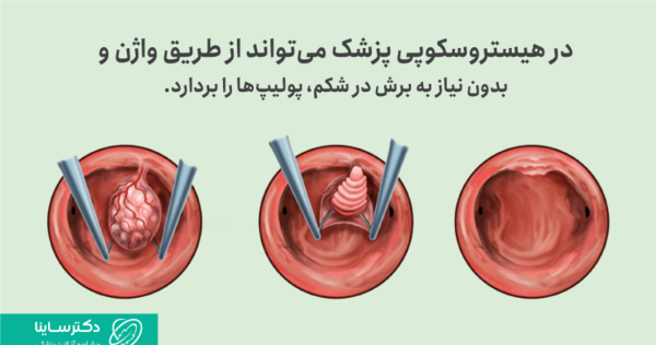 عکس پولیپ رحم