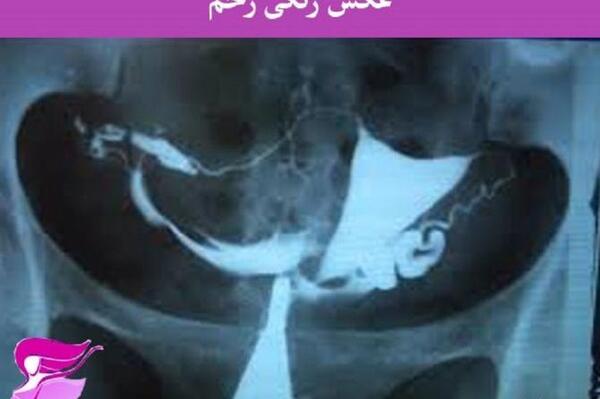 عوارض عکس رنگی رحم نی نی سایت