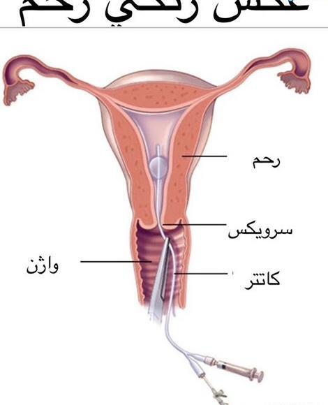 عوارض عکس رنگی رحم نی نی سایت