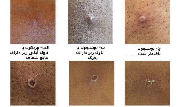 عکس بیماری آبله میمون
