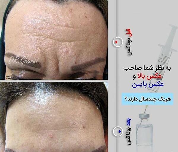 عکس بوتاکس پیشانی