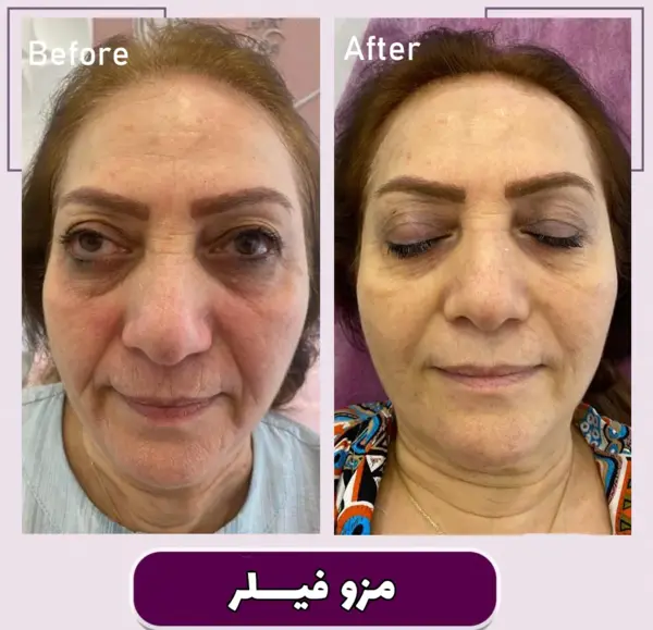 عکس قبل و بعد جالپرو
