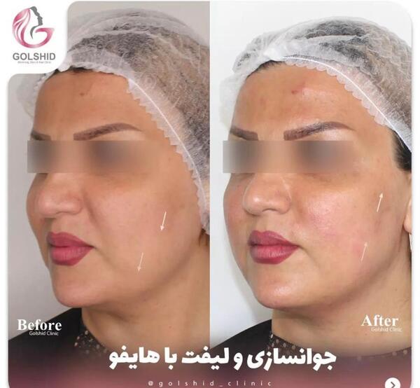 عکس قبل و بعد جالپرو