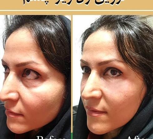 عکس قبل و بعد جالپرو