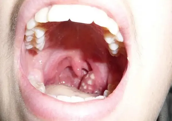 عکس لوزه