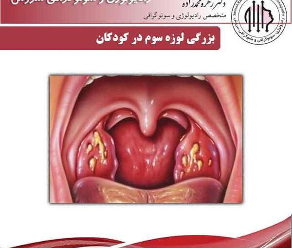 عکس لوزه