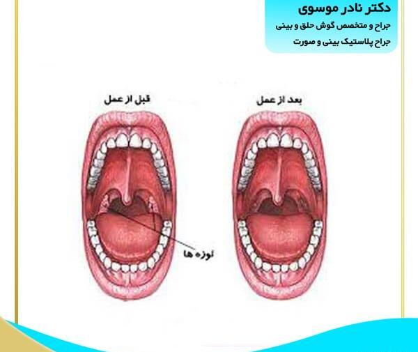 عکس لوزه