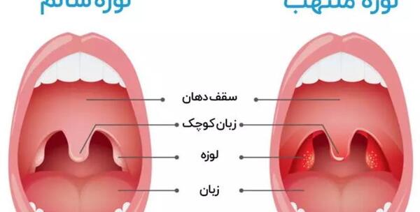 عکس لوزه