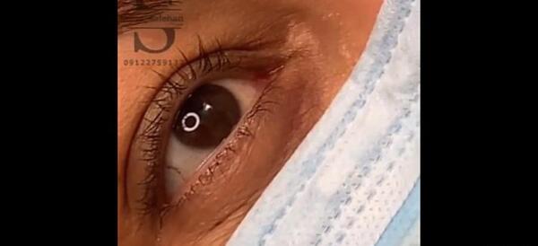 عکس زدن بن مژه