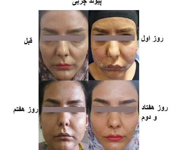 عکس ورم صورت بعد از تزریق ژل