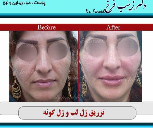 عکس ورم صورت بعد از تزریق ژل