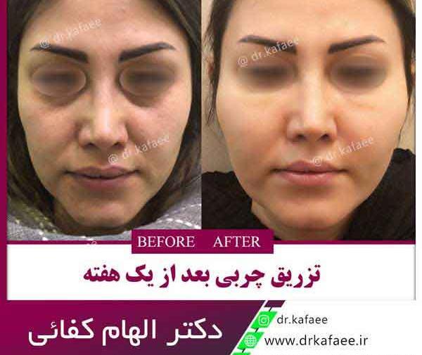 عکس ورم صورت بعد از تزریق ژل