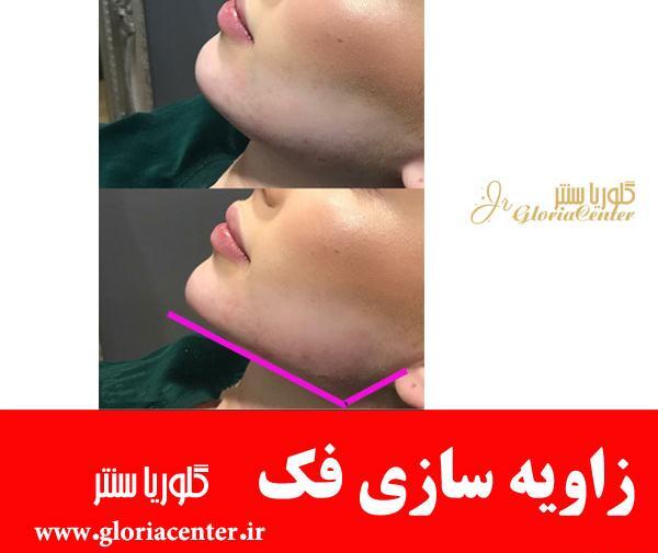 عکس ورم صورت بعد از تزریق ژل