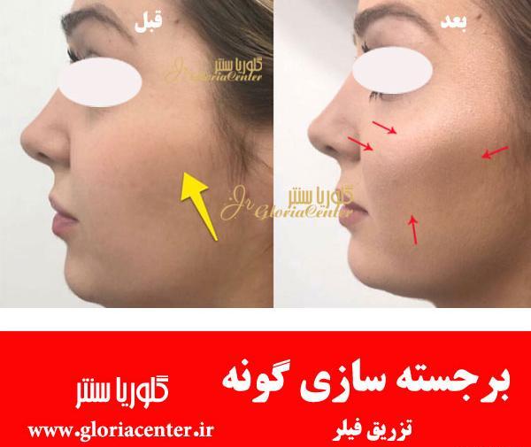 عکس ورم صورت بعد از تزریق ژل