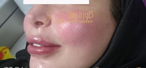عکس ورم صورت بعد از تزریق ژل