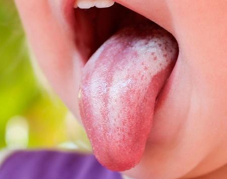عفونت قارچي عکس حساسیت نوزاد به پوشک