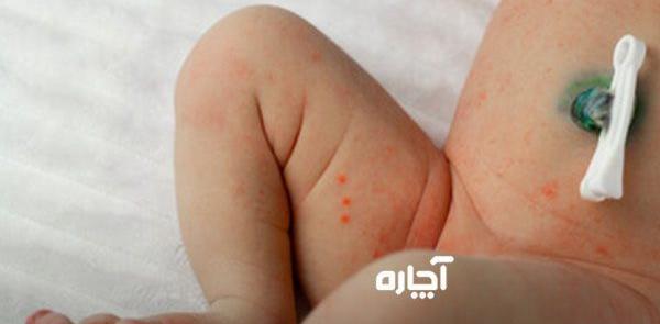 عفونت قارچي عکس حساسیت نوزاد به پوشک