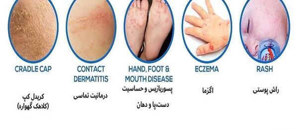 عفونت قارچي عکس حساسیت نوزاد به پوشک