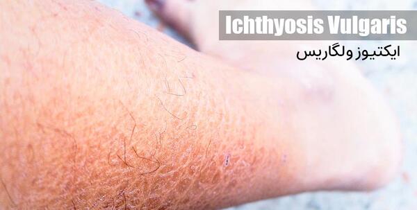 عکس نوزاد ایکتیوز