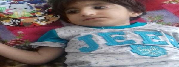 عکس نوزاد میکروسفالی