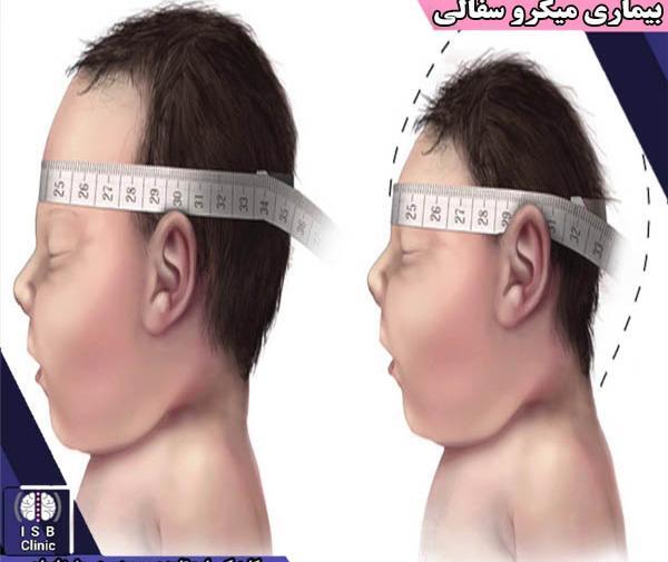 عکس نوزاد میکروسفالی