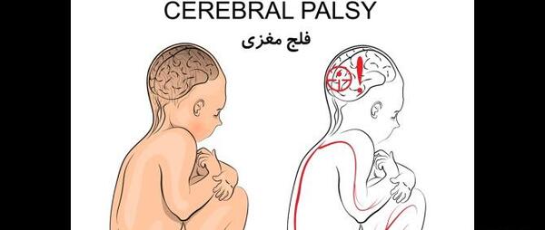 عکس نوزاد فلج