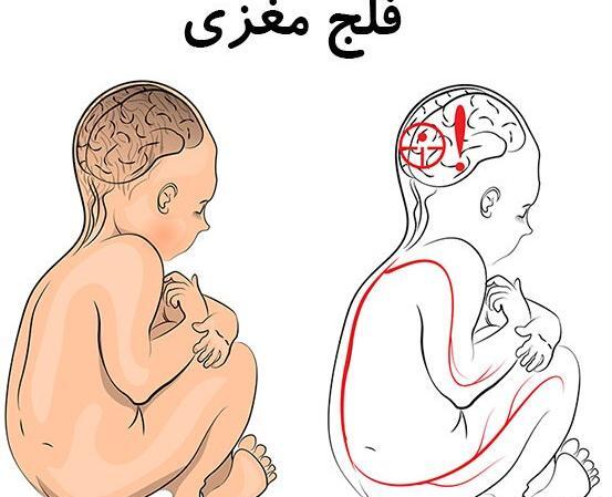 عکس نوزاد فلج
