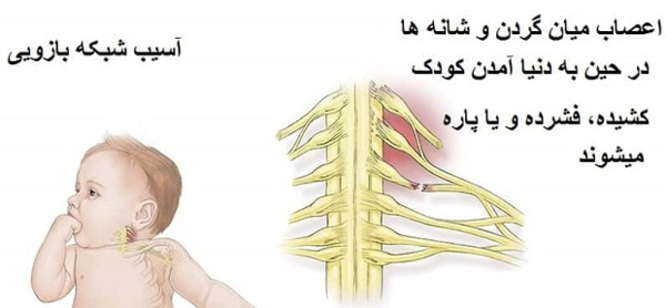 عکس نوزاد فلج