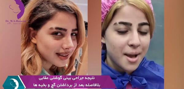 عکس جراحی زیبایی دختر 15 ساله