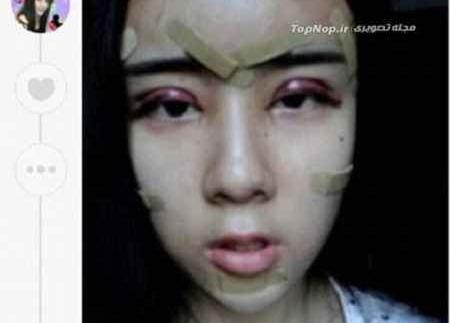 عکس جراحی زیبایی دختر 15 ساله