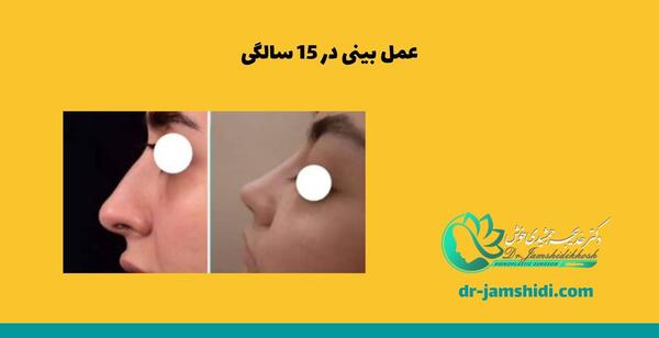 عکس جراحی زیبایی دختر 15 ساله