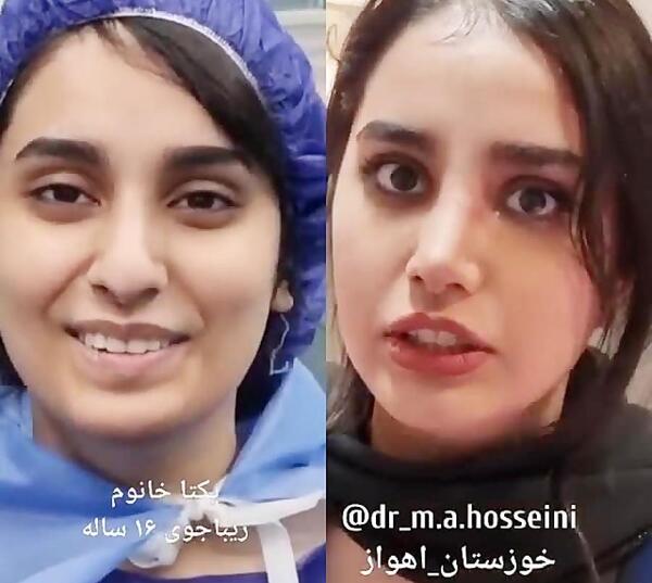 عکس جراحی زیبایی دختر 15 ساله