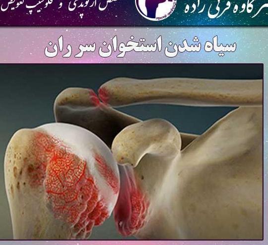 عکس سیاه شدن استخوان پا