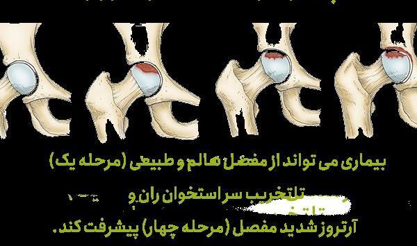 عکس سیاه شدن استخوان پا